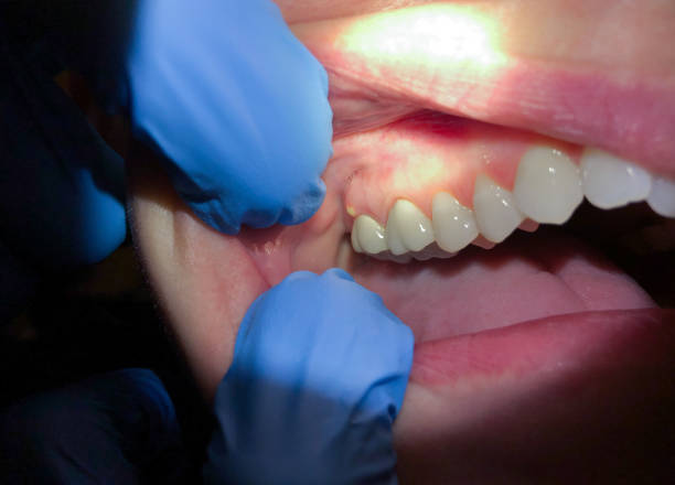Best Emergency Tooth Extraction in Commerce, TX