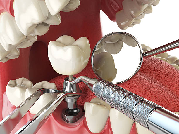 Best Emergency Wisdom Teeth Removal in Commerce, TX
